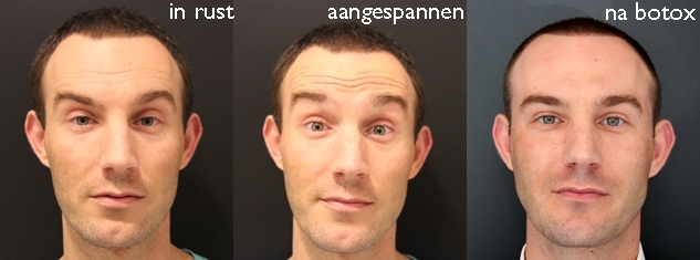 Dit zijn de 5 meeste voorkomende cosmetische ingrepen bij mannen