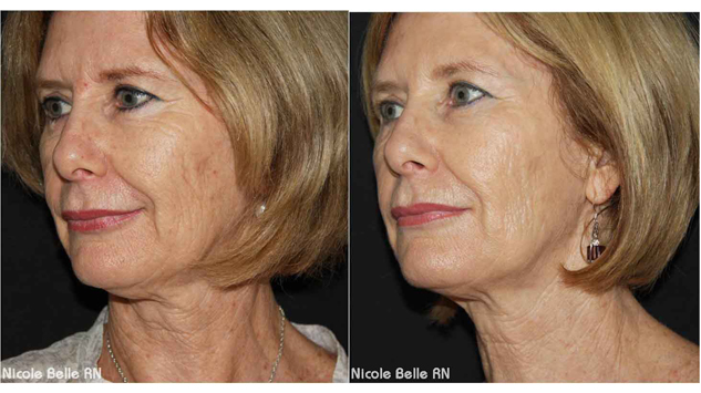 Korting op Vampire Facelift behandeling