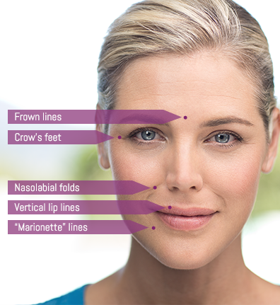 Wat is het verschil tussen botox en fillers?