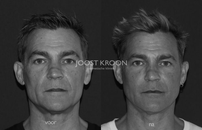 Bas (46) in beeld over injectables