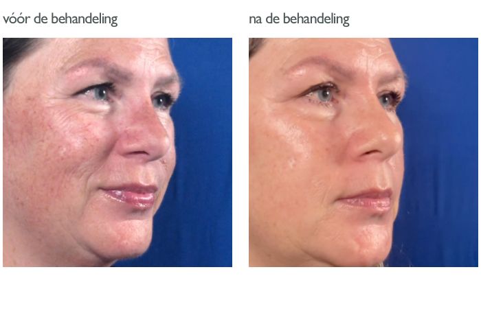 Photo Facial /IPL voor en na 1