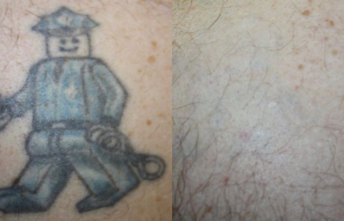 Tatoeage verwijderen voor en na