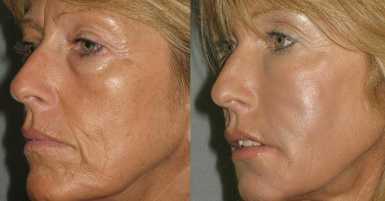 Liquid Facelift