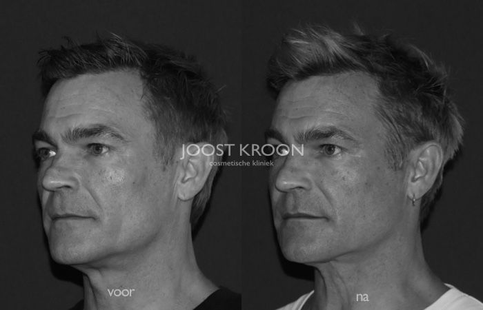 Bas (46) in beeld over injectables