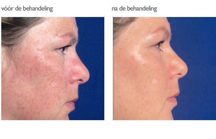 Photo Facial /IPL voor en na 2