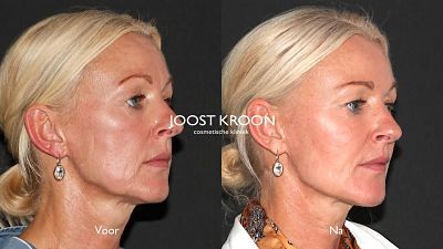 joost kroon voor en na liquid facelift