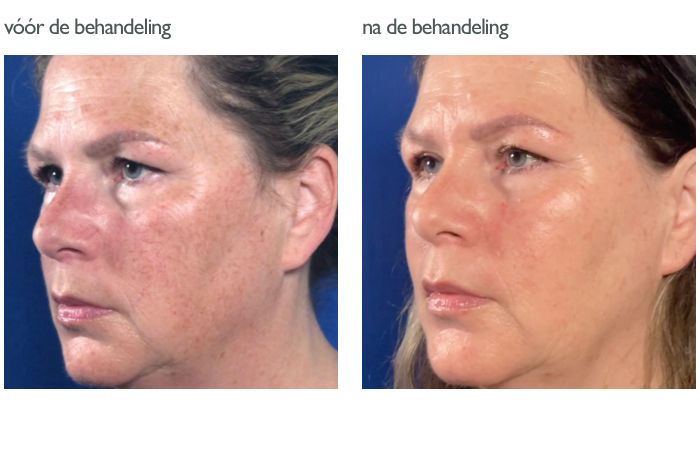 Photo Facial /IPL voor en na 3