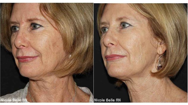 Vampire Facelift