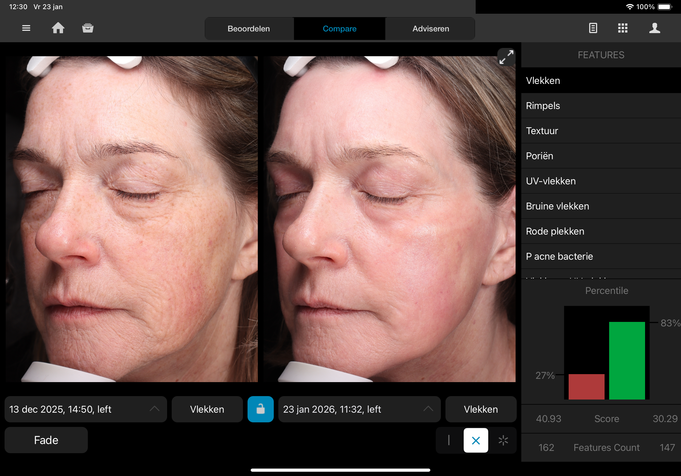 Contour TRL laser