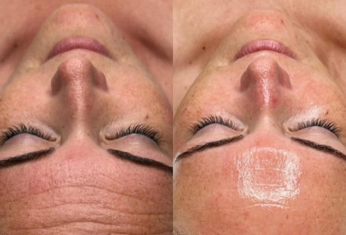 hydrafacial