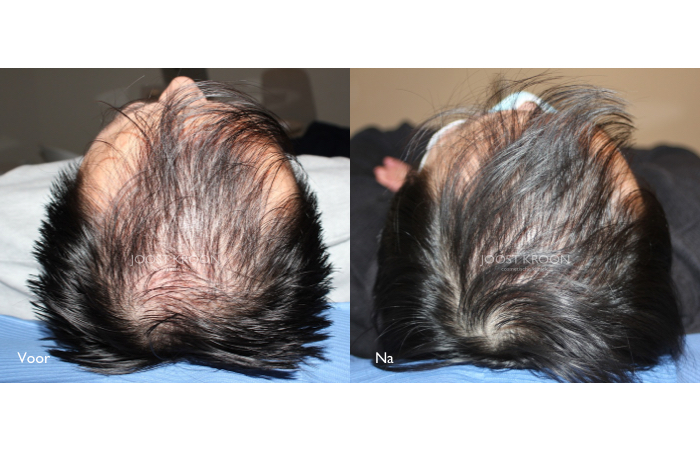 Vermelding Giotto Dibondon Frank Worthley XL Hair behandeling: een pijnloze stimulatie van de haargroei - Joost Kroon